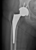 Hip Replacement Surgeons Adelaide by AHKC